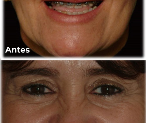 Antes e depois da ortodontia